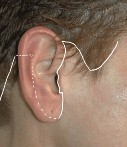 facelift incision