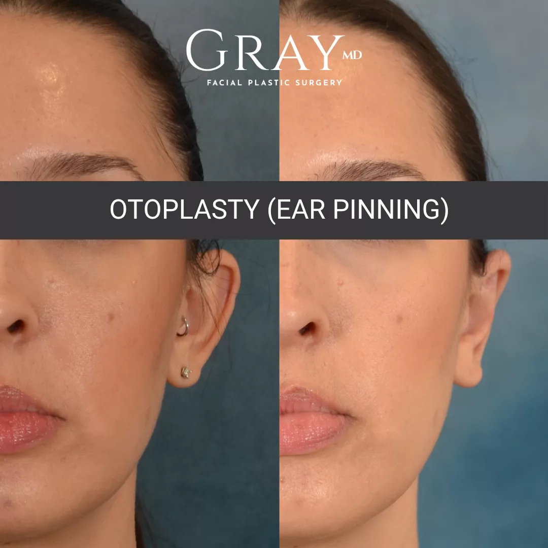 Patient_01_Otoplasty (Ear Pinning)