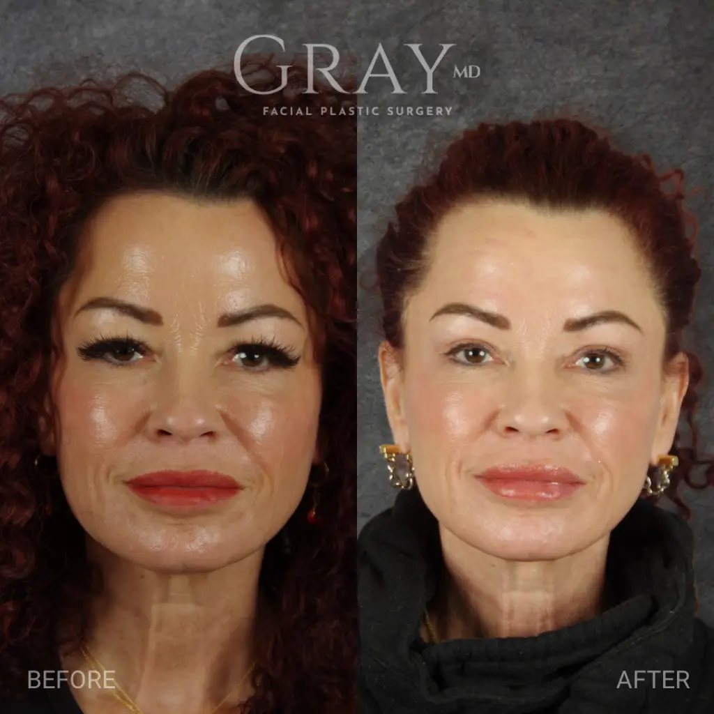 Upper Blepharoplasty