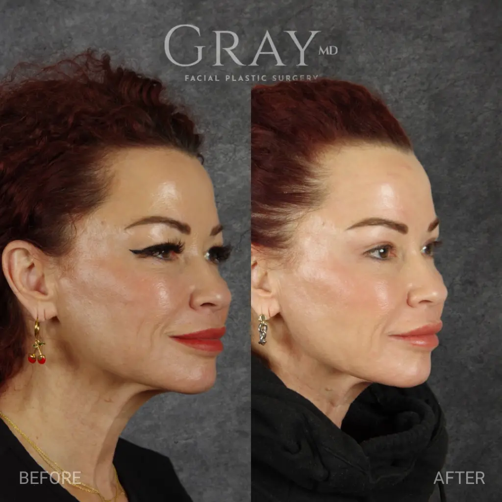 Upper blepharoplasty