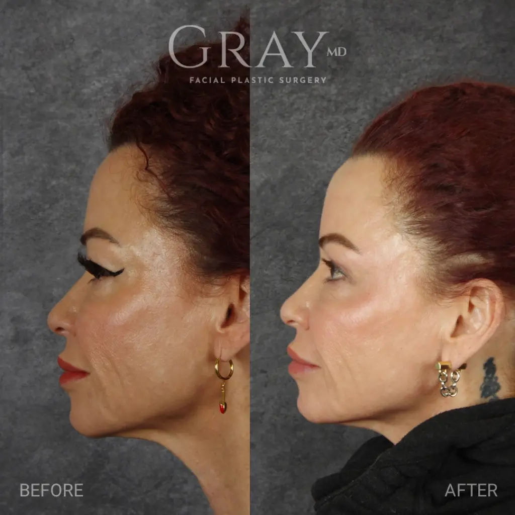 Upper blepharoplasty