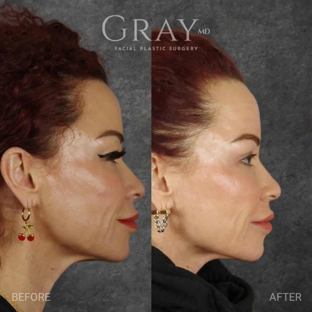 Blepharoplasty