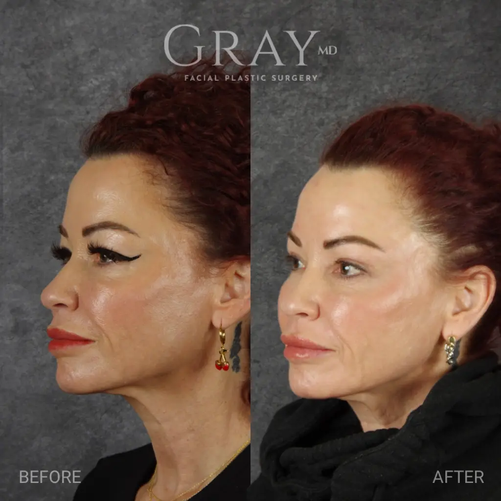 Upper eyelid lift