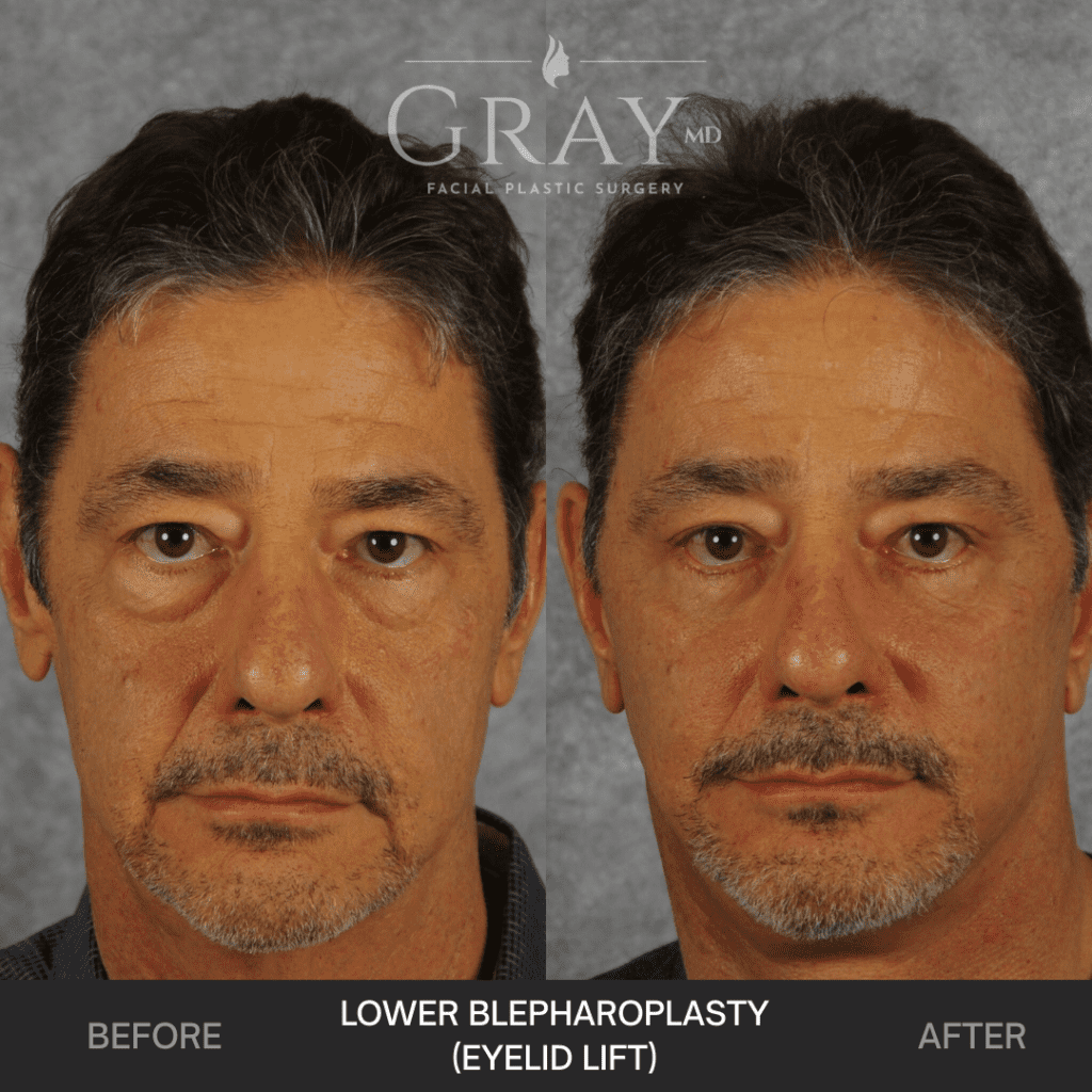 Lower blepharoplasty