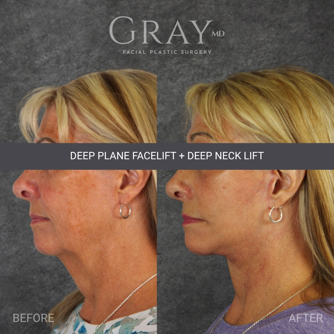 Copy of Lip Lift