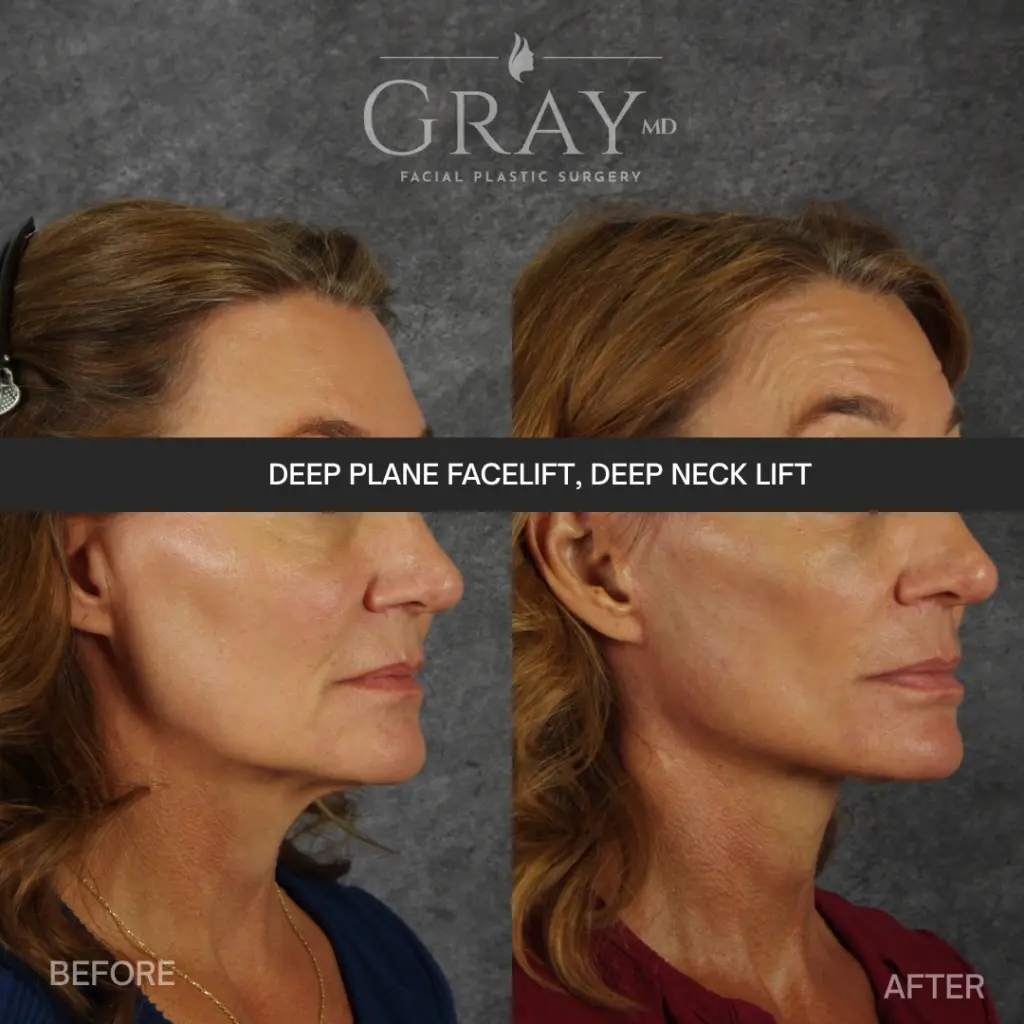 Deep plane facelift