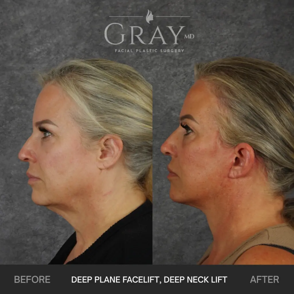 Left Profile B and A