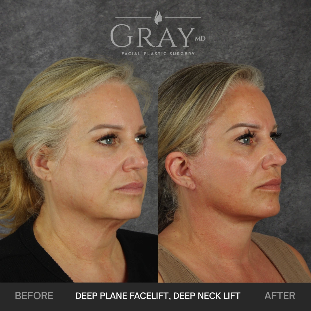 Deep plane facelift before and after