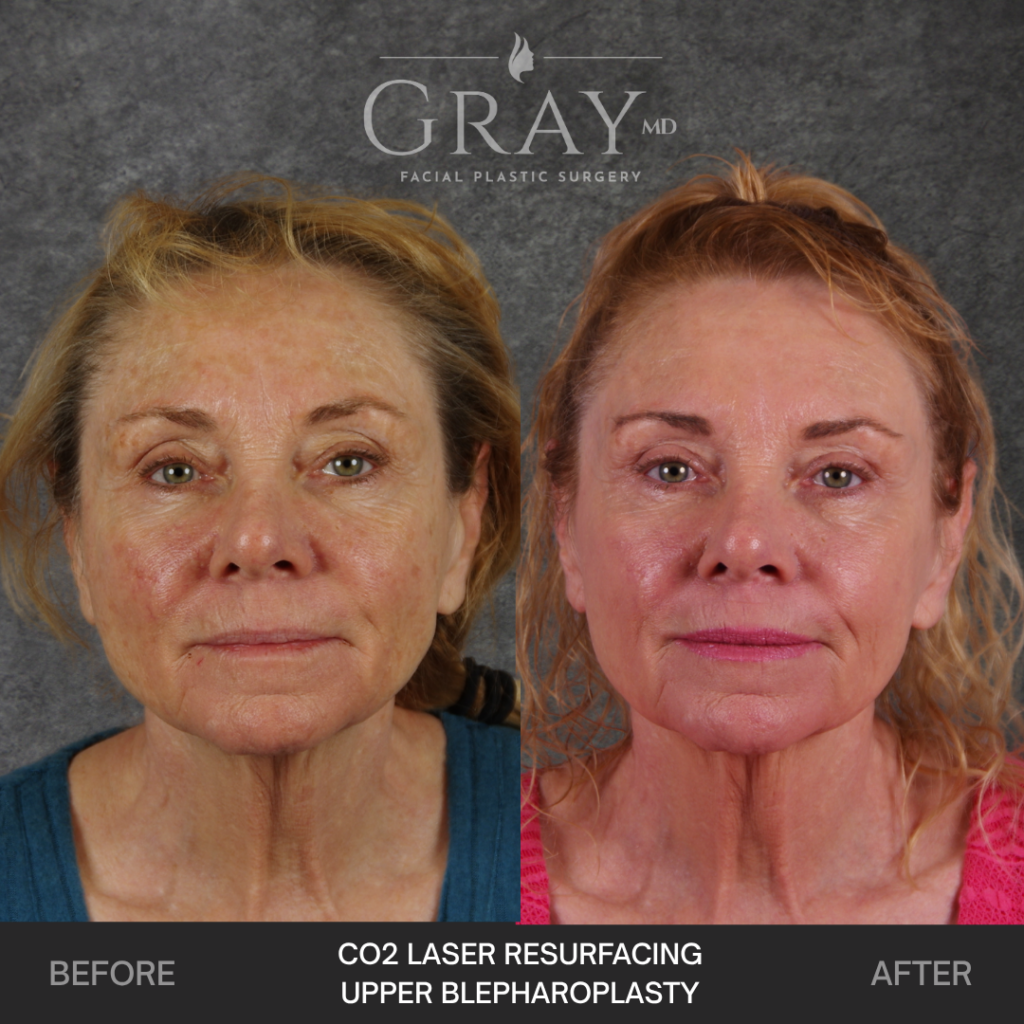 laser resurfacing