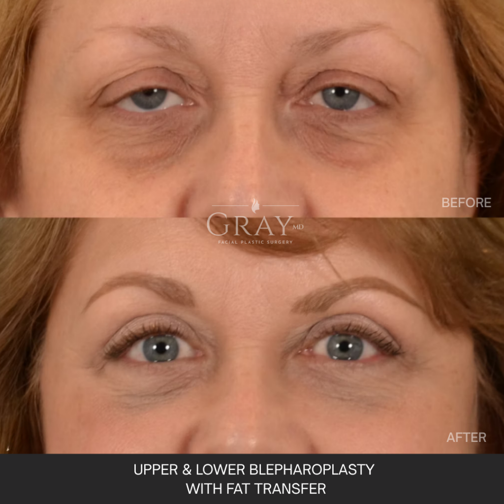 .Upper and Lower Eye Frontal