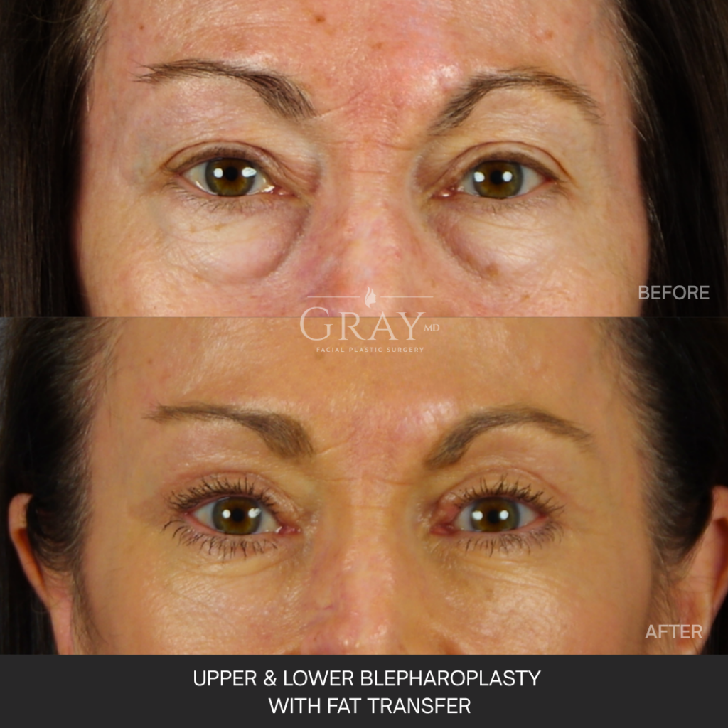 Upper and Lower Eye Frontal